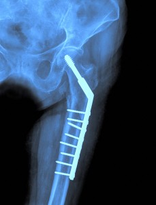 X-ray of the hip prosthesis